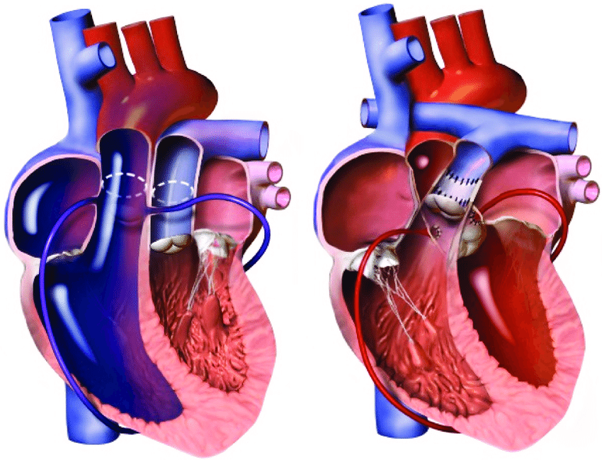 Arterial Switch Operation